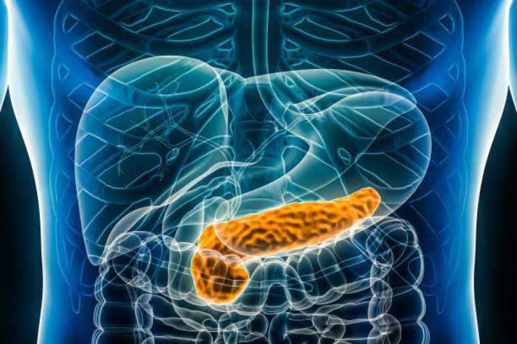 Sintomo del tumore al pancreas