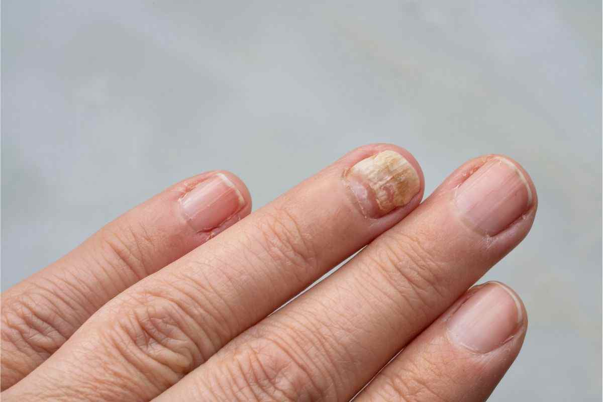 unghie spezzate sintomo tumore